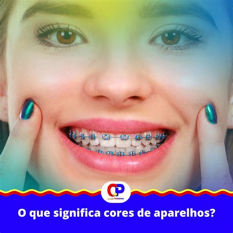 Cores de Aparelho – Dicas Exclusivas Para Você .